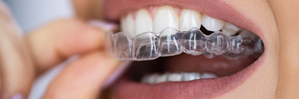 "Invisalign"
